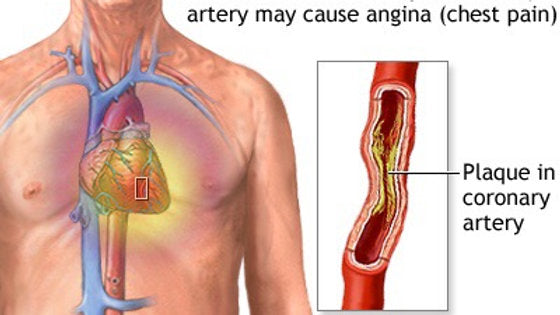 ANGINA