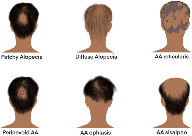 Alopecia