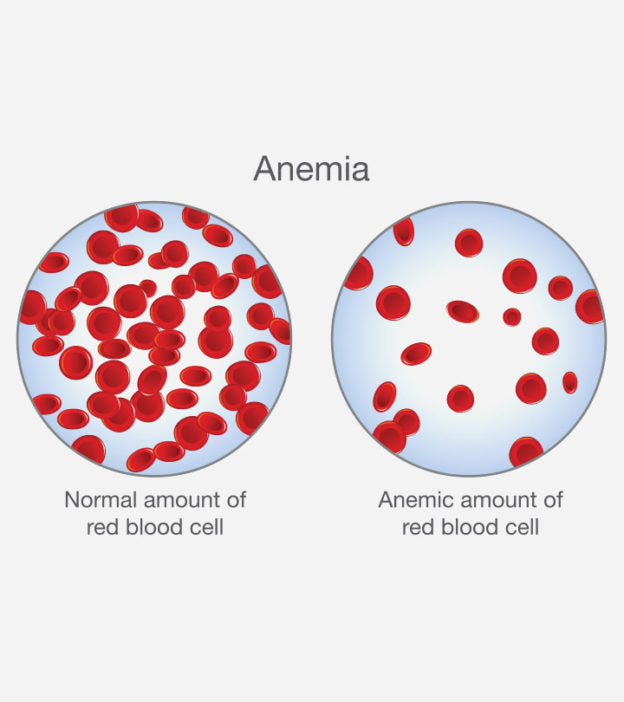 Anemia
