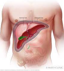 ENLARGED LIVER