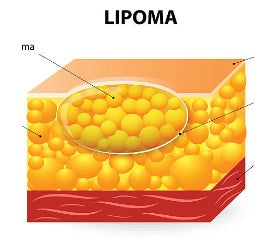 Lipoma