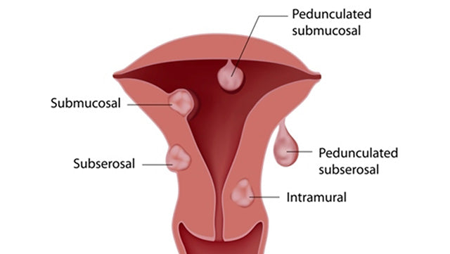 Vaginitis (Vaginal Infection)
