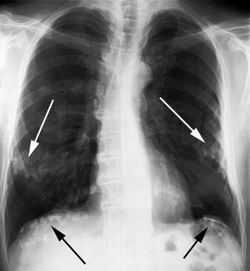 Pleural fibrosis (one month supply)