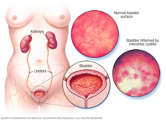 Interstitial Cystitis