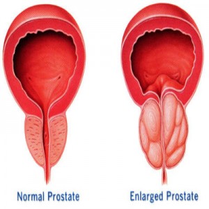 Prostate Enlargement