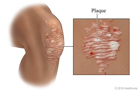 Psoriasis