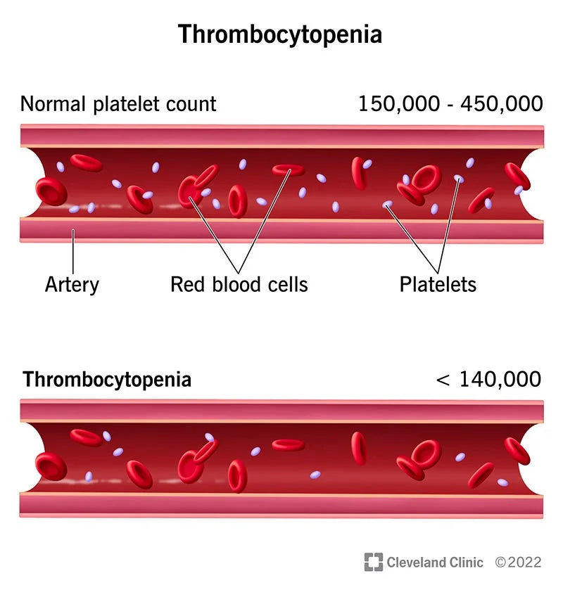 Thrombocytopenia (low blood platelets)