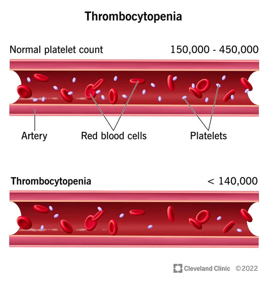 Thrombocytopenia (low blood platelets)