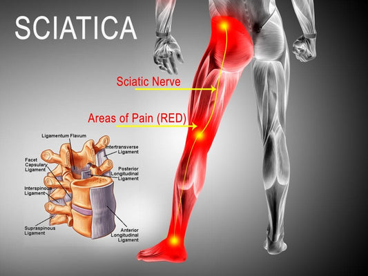 Sciatica Nerve Pain