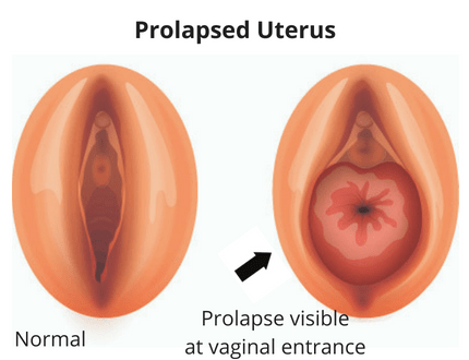 Prolapse Uterus
