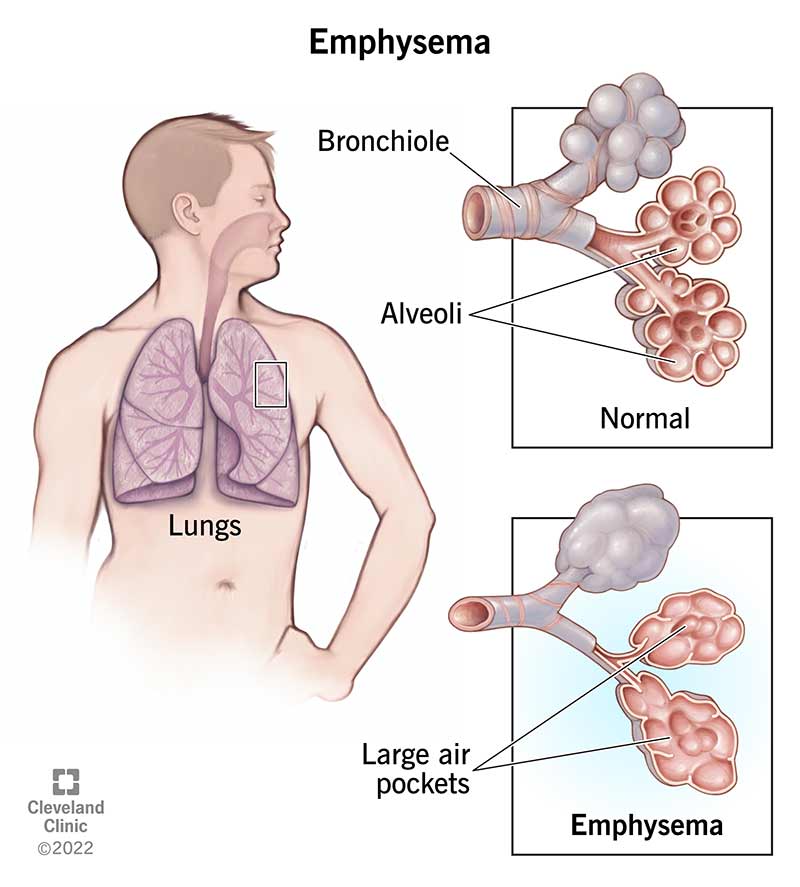 Emphysema